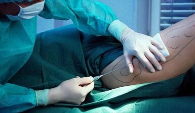 bariatric surgery